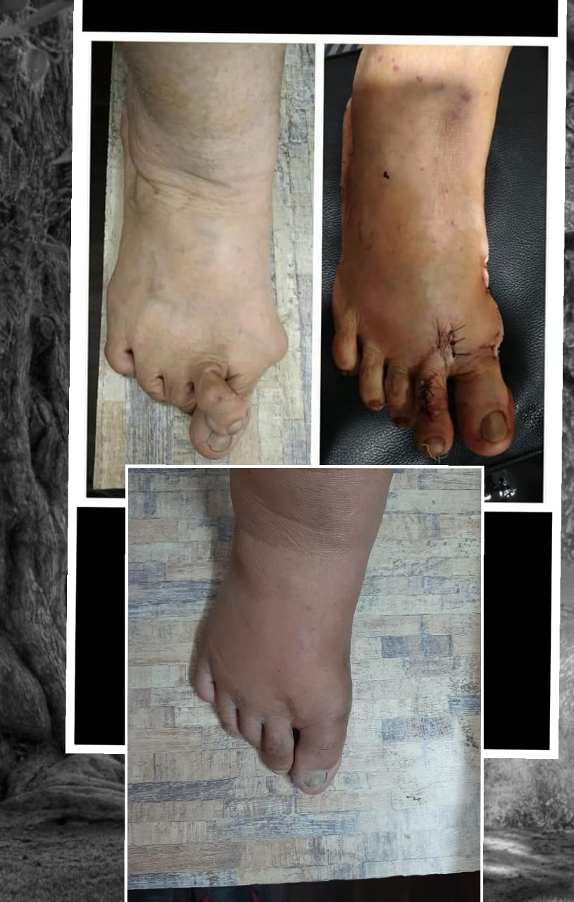 Bunions case solved by Dr. Girish Motwani