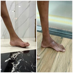 Severe foot deformity- Cavovarus foot- Dr Girish Motwani