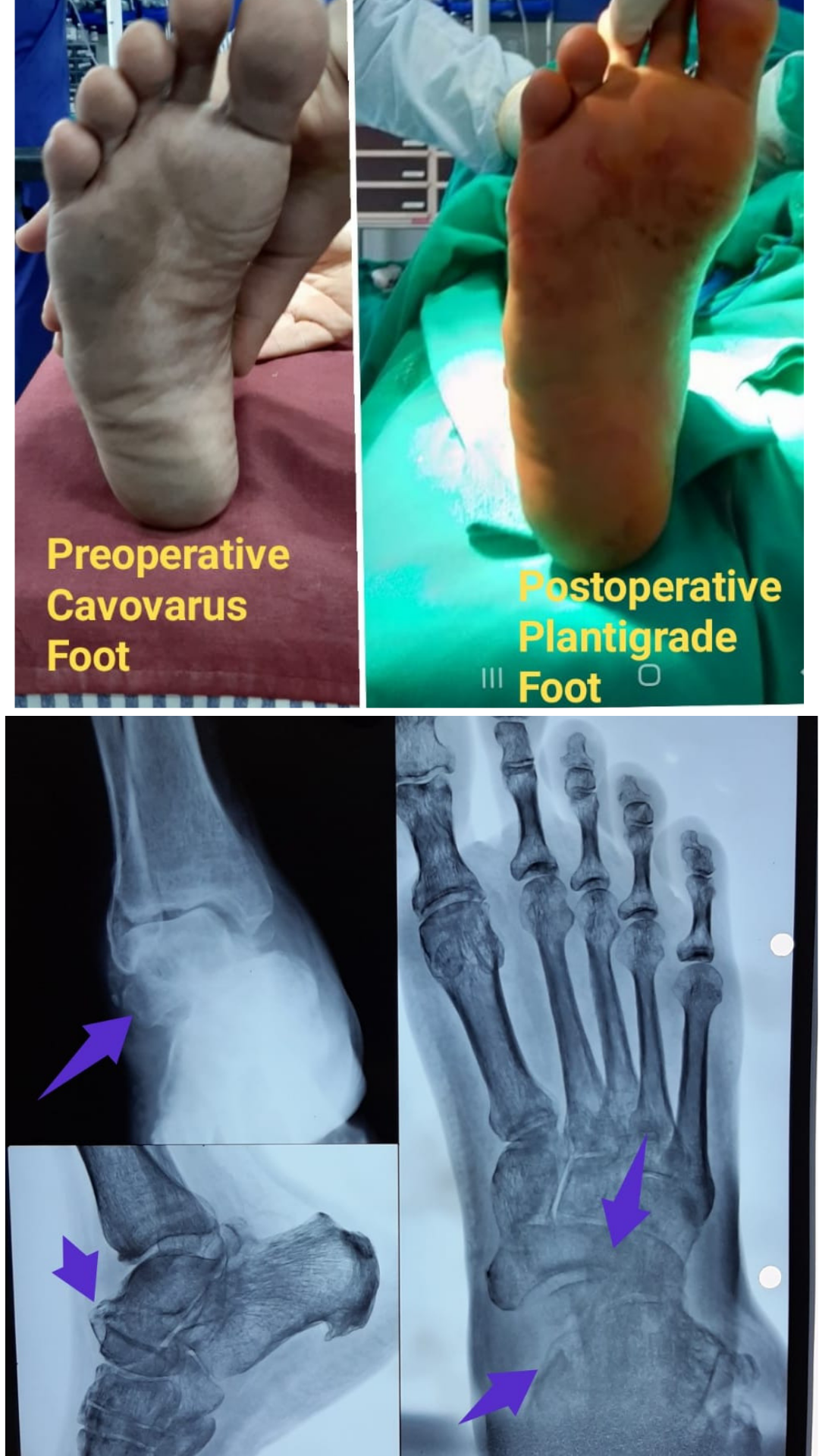 Management of difficult neglected foot and ankle injuries