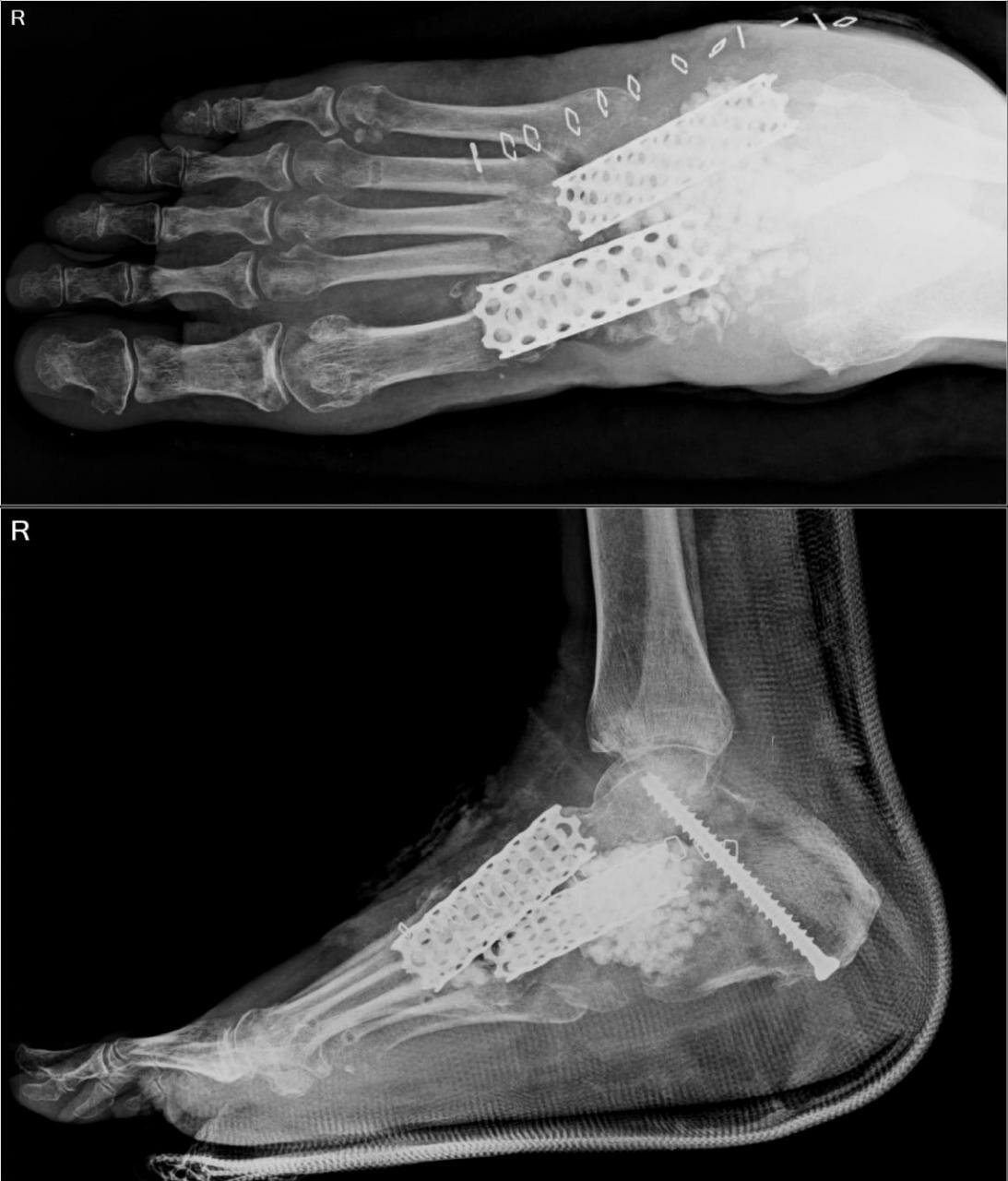 Use of metallic cage for Midfoot &amp; hindfoot bone defect - first time in India
