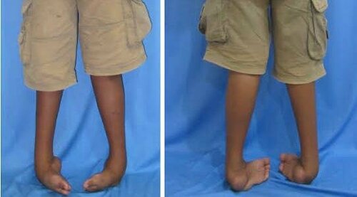 Structural Clubfoot Correcting Recurrent Rigid Clubfoot Deformity with Surgical Expertise ...