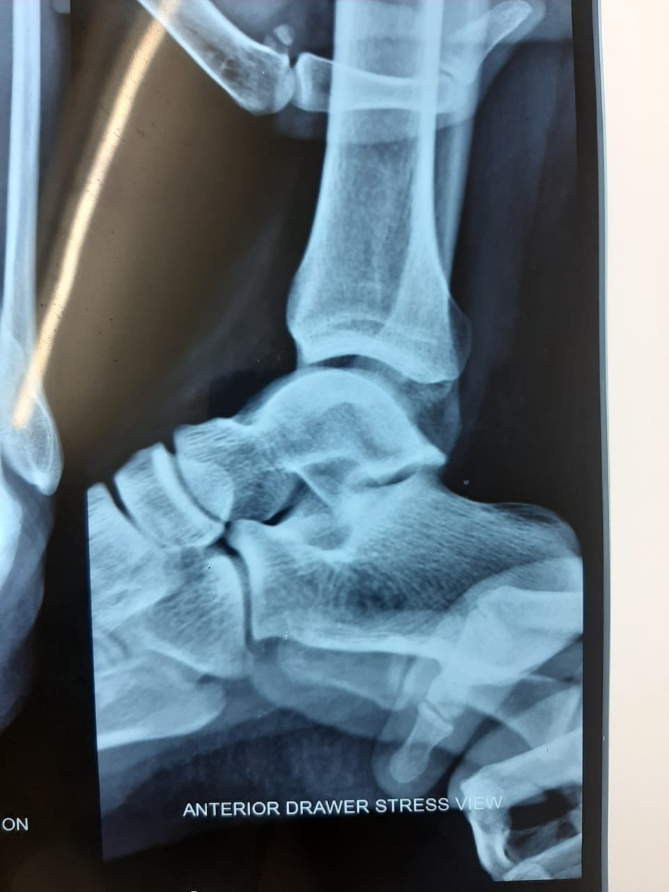 Don\\\'t underestimate simple ankle sprain?