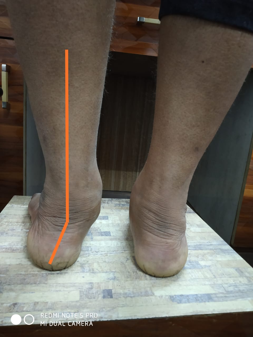 Flat foot deformity Suyog Hospital